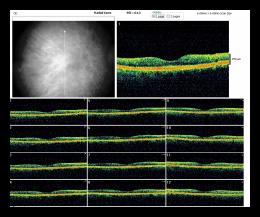 RADIAL LINE OD